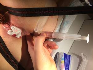 chubby girl injection - Female rectal injections | MOTHERLESS.COM â„¢