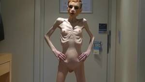 anorexic skinny girl - Anorexia Christin showing her Bones & Skinny Skeleton
