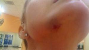 Bruises Porn - Erin Andrews Has Been Posting Pictures Of Various Bruises In Recent Days