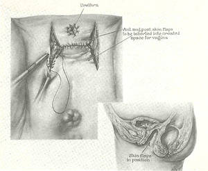 anotomical transexual anal illustration - Figure 10. The preservation of the vaginal cavity is assured by use of a  suitable vaginal form.