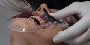 Mouth Dental - MOUTH RETRACTOR DENTIST UPPER PERMANENT RETAINER - Tnaflix.com