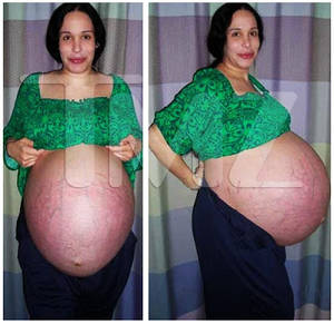 Before And After Mom - Octomom Before After