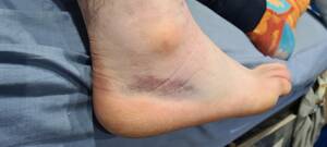 foot heel bruise - Update on my ankle from yesterday's post. I got it xrayed just in case, no  breaks or fractures but it's very swollen and bruised : r/NewSkaters