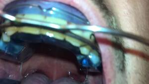 Braces Headgear Porn - New Braces Retainer and Twinblock with Headgear for new Aventures -  Pornhub.com