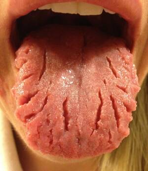 Disgusting Porn Tongue - Fissured Tongue - a completely benign medical condition : r/WTF