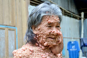 Disfigured Guy Porn - Disfigured man forced to live as a recluse finally returns to his home city  after 45 years to pay respects to the late King of Thailand