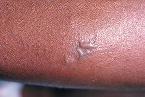 Baby Born With Warts On Anal Area - 