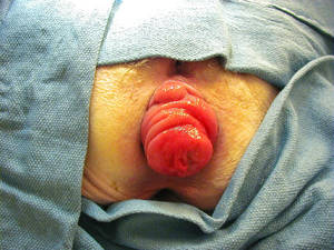 anal thrombosis - Anus or Rectum Surgery
