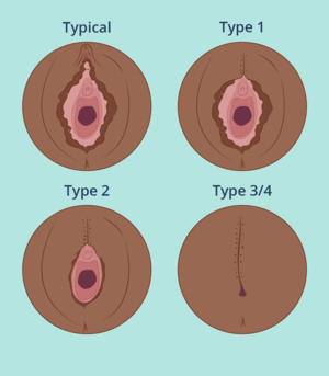 Circumcised Vagina Female Circumcision Porn - Female genital cutting - LoveMatters Africa