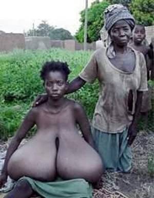 gigantomastia boob galleries - gigantomastia - Bing images