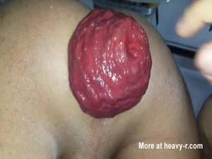 Anal Prolapse Sex Black - Anal prolapse