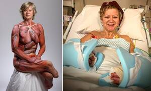 Forced Quadruple Amputee Porn - Incredible quadruple amputee has a hand transplant after dreaming of  holding son's hand | Daily Mail Online