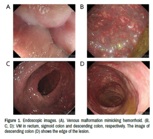 anal thrombosis - A 12-Years Rectal Bleeding Complicated with Deep Vein Thrombosis, Is  Hemorrhoid the Real Cause?