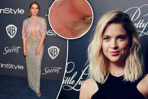Ashley Benson Porn Bondage - Ashley Benson shows off anxiety-induced rash on her body