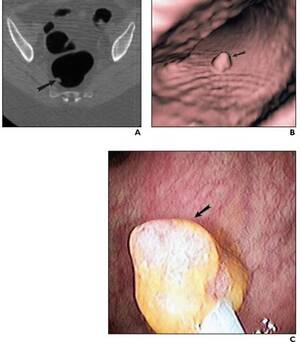 anal polyp - St. Vincent Healthcare among hospitals using virtual colonoscopies