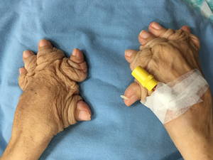 nails tease penishands - Plummer-Vinson Syndrome ...