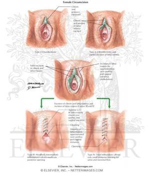 Circumcised Vagina Female Circumcision Porn - This is what Islamists practice for the subjugation of girls & women:- Female  Genital Mutilation.
