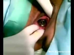 Awful Pussy Torture - Lightbulb Surgically Removed From Vagina