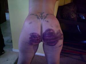bruised ebony ass - Bruises after spanking - Spanking Pictures and Videos | MOTHERLESS.COM â„¢