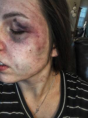 Bruises Porn - Bruises | MOTHERLESS.COM â„¢