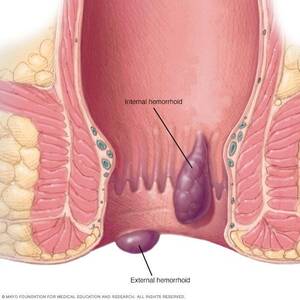 anal thrombosis - Bulging around the anus . XXX Sex Images.