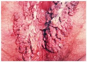 internal anal warts - Perianal aka Peri-Anal here read posts over web who wrote scratch, check  relations scratch warts? Answer yes, but correctly. Curl inwards grow  sideways into ...