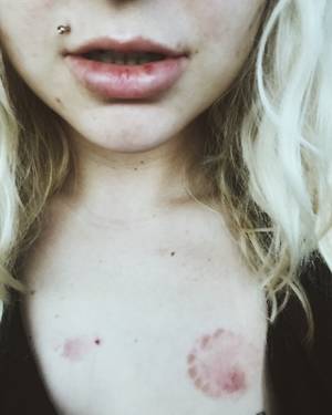 Bruises Porn - Loading image of anamaul.