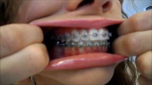 Braces Fetish Porn Tumblr - Braces Mouth exam and tour - ThisVid.com