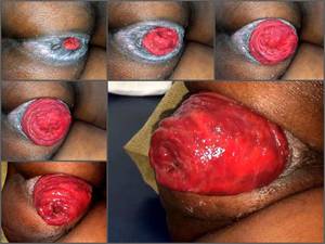 ebony double anal prolapse - anal prolapse porn,ebony anal prolapse,wife anal prolapse,prolapse video, prolapse