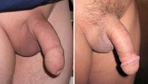 Circumcised Vs Uncircumcised Porn - File:Uncircumcised and circumcised penis.JPG - Wikimedia Commons