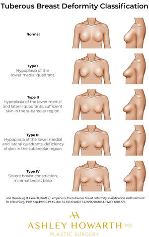 misshapen breasts - Would you date a woman with deformed breasts? - Sexuality