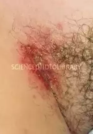 Herpes Porn Doctor - How are they filming porn scenes with performers with herpes? - Quora