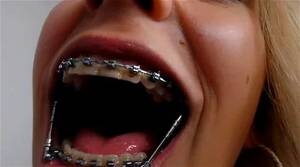 Braces Headgear Porn - Watch Request - @PLINE @NGEL - Alpine, Braces, Herbst Porn - SpankBang