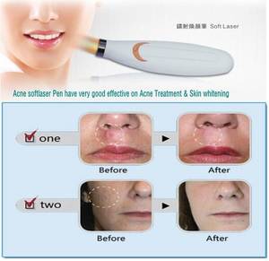 Acne Pussy - Cheap lllt, Buy Quality lllt laser therapy directly from China lllt laser  Suppliers: Softlaser Skin Care Low Level Cold Soft Laser Therapy Wrinkles  Acne ...