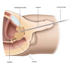 Male Sounding Cum - Using Penis Plugs