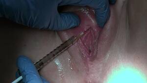 needle injection - O-Shot clit injection 01 - ThisVid.com