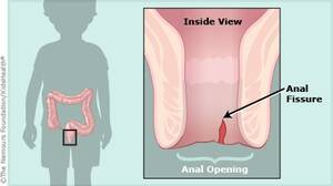 clips4sale anal - A to Z: Anal Fissure (for Parents) - East Tenneesee Children's