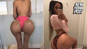 big fat pussy kim kardashian - Model injects butt with four pints of fat to look like Kim Kardashian | New  York Post