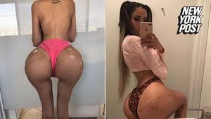 faking fatt girls from ass - Model injects butt with four pints of fat to look like Kim Kardashian | New  York Post