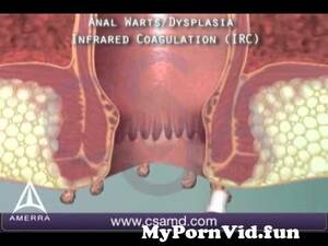 internal anal warts - Anal warts & infrared coagulation treatment - 3D animation from analm Watch  Video - MyPornVid.fun