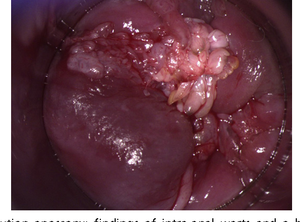 internal anal warts - Anal warts account - Porn clips.