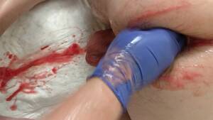 Bleeding Fisting Porn - Cunted: fisting3 - ThisVid.com