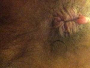 hard anal lump - Lump in the anus . XXX Sex Photos.