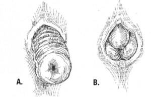 anal distention - Rectal prolapse