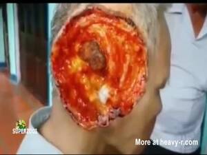 infection from anal sex - Bizzare Facial Infection