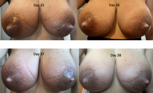 Breast Engorgement Porn - Mastitis, Engorgement, and Breast Complications (with Images)