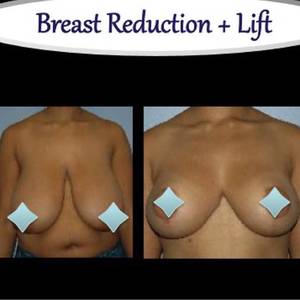 Breast Lift Porn - Before and After. Actual patient. Breast reduction / lift (no implant).