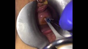 Extreme Catheter Porn - Cervix extreme gyno play - XVIDEOS.COM