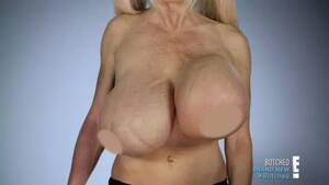 Huge Titty Porn Implant - Porn star with GIANT 4000cc breast implants asks Botched doctors for help  after she springs a leak - Mirror Online