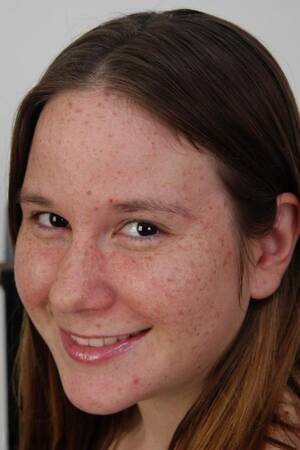 Acne Porn Chubby - Chubby Face Porn Pics - PornPics.com